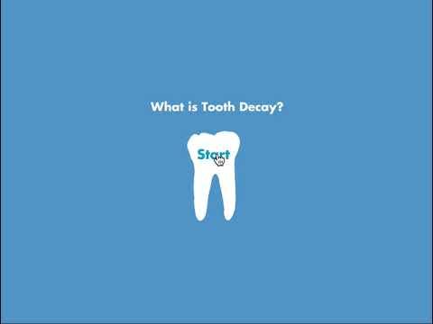 What is tooth decay?